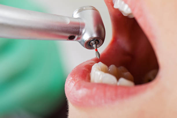 Best Emergency Wisdom Teeth Removal in Leitchfield, KY